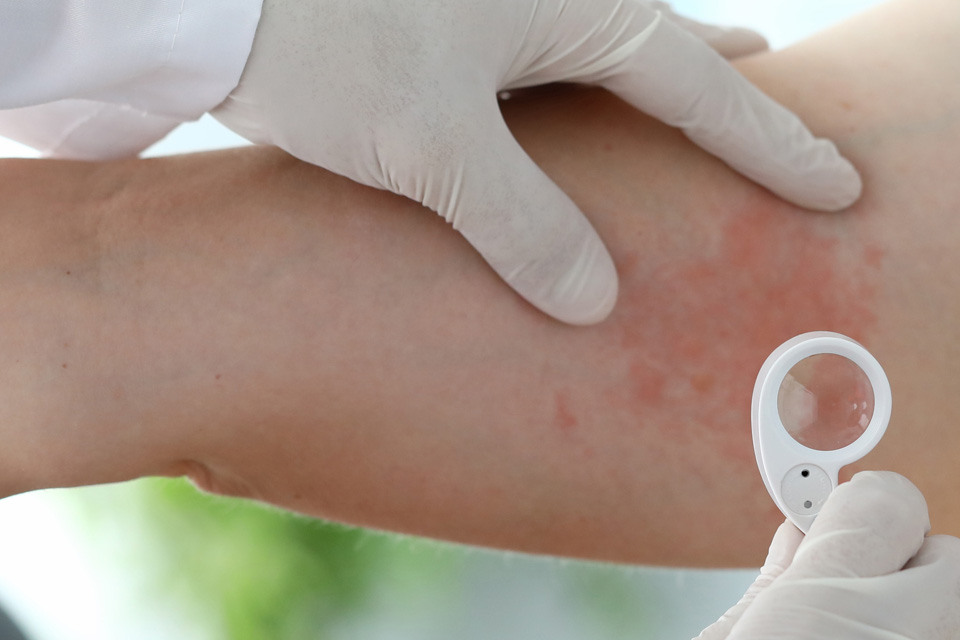 Basic Life Support and Management of Anaphylaxis